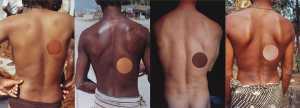 Proposal for Skin Transplant